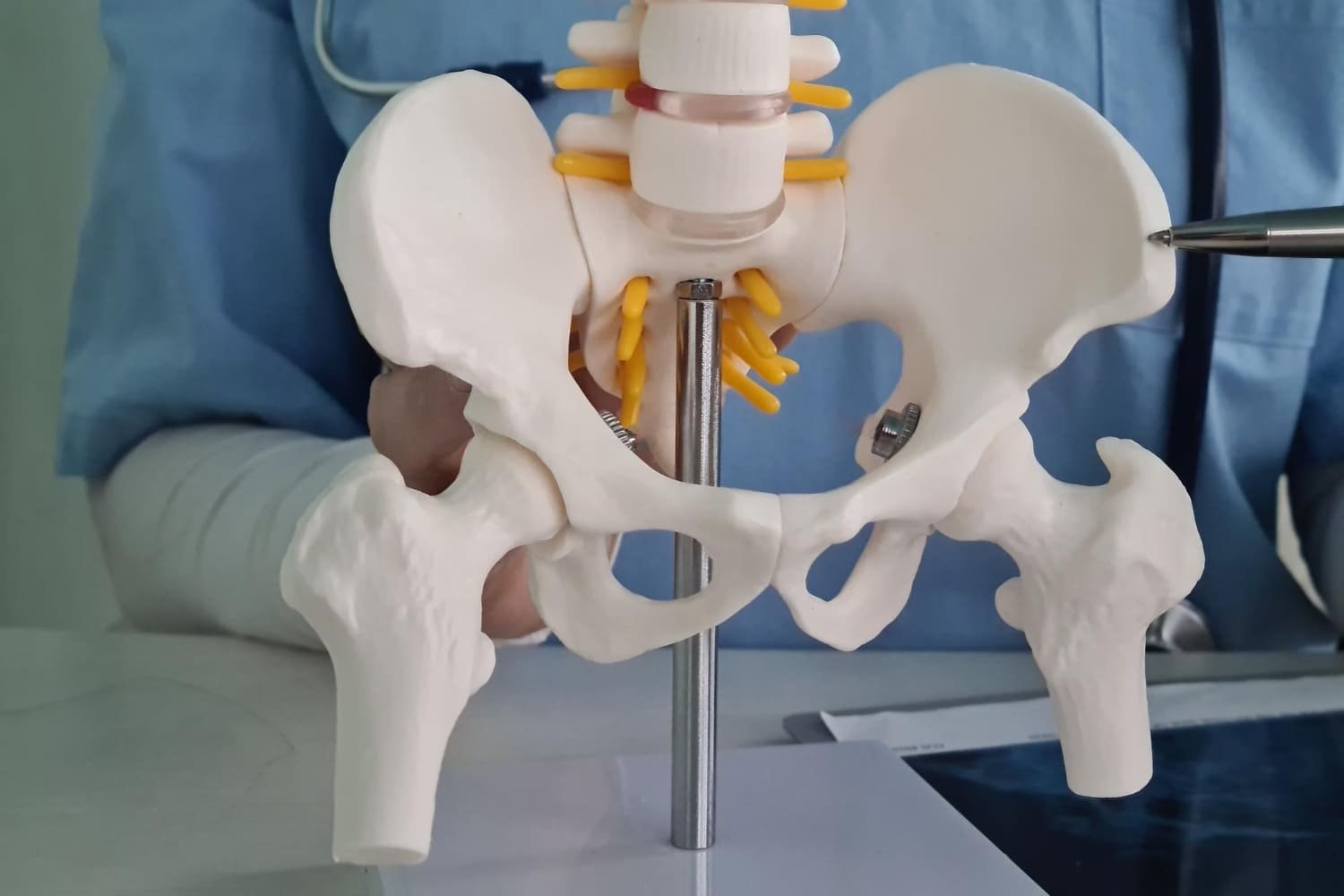 Artroplastia total de cadera